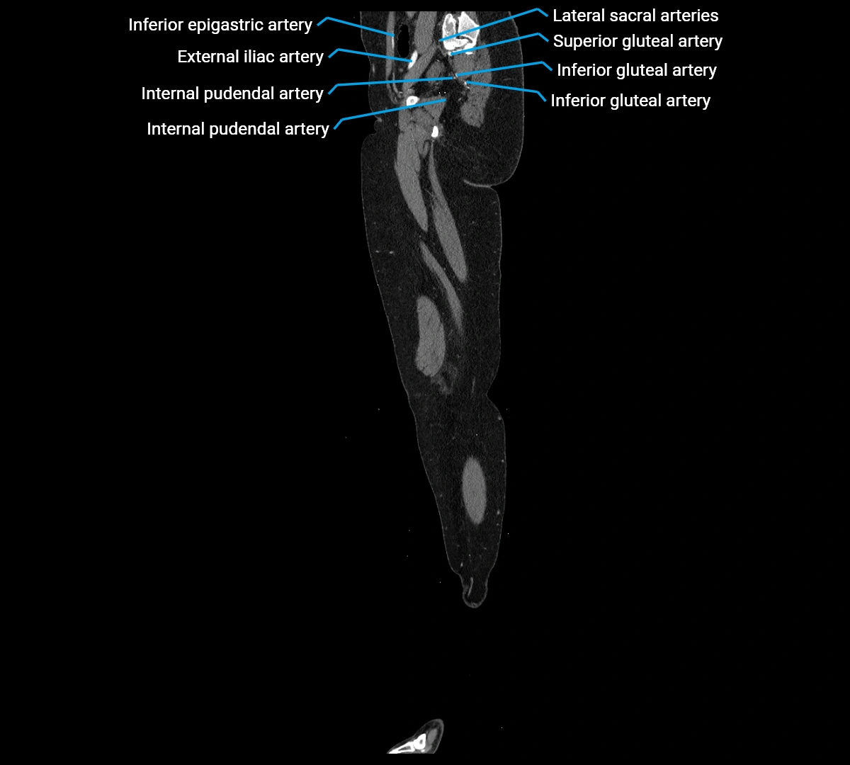 CTA lower limb sagittal cross sectional anatomy labelled image _18 (2).webp